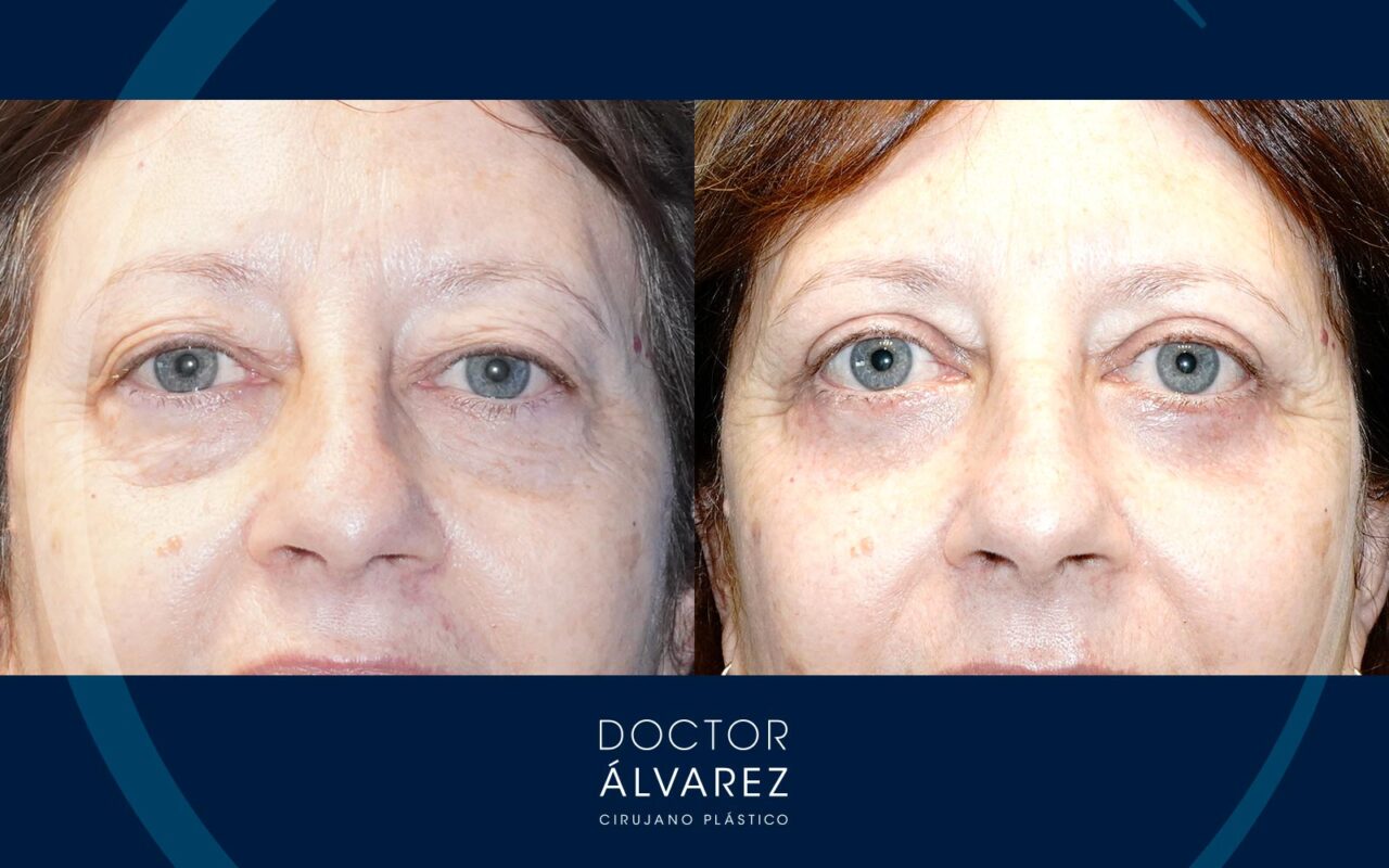 Caso De Blefaroplastia Superior E Inferior Doctor Lvarez