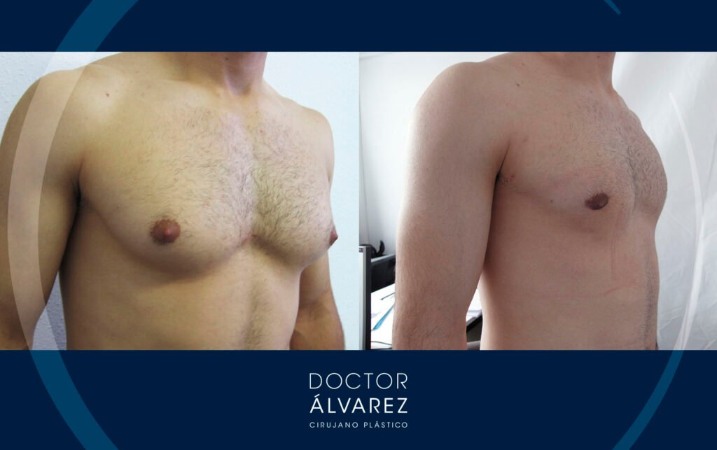 caso real de ginecomastia fotos antes y despues