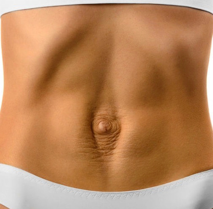 Imagen artículo mini abdominoplastia mini abdominoplastia