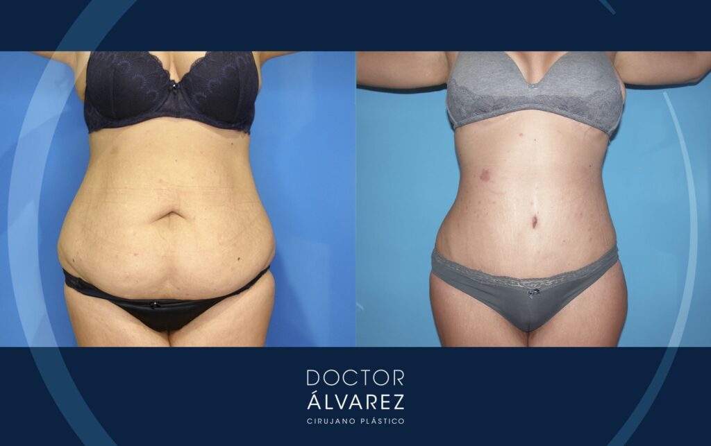 1 resultado con antes y después de abdominoplastia y liposuccion