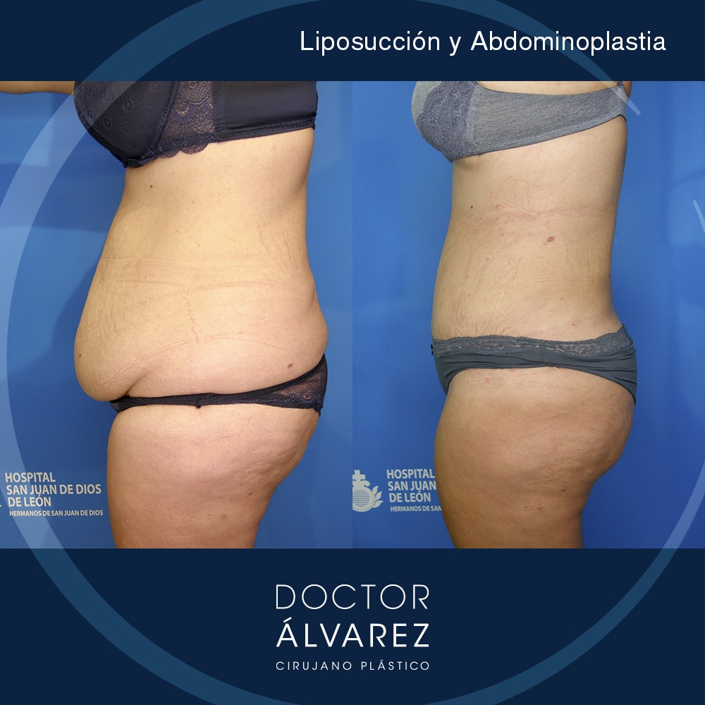 https://cirugiaesteticaplastica.es/caso-liposuccion-y-abdominoplastia/