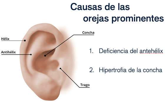 Causas Orejas prominentes o de soplillo Causas Orejas prominentes o de soplillo
