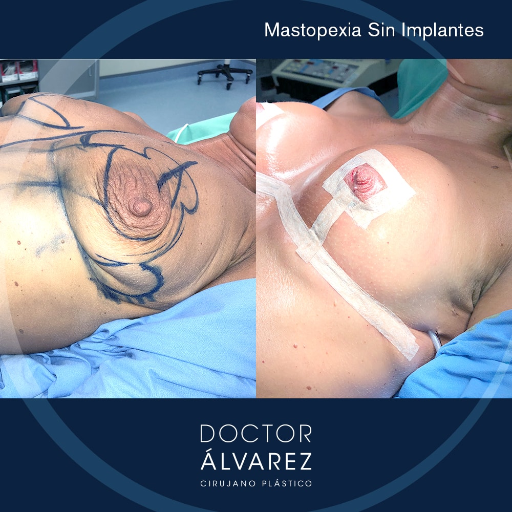https://cirugiaesteticaplastica.es/caso-real-de-mastopexia-sin-protesis/