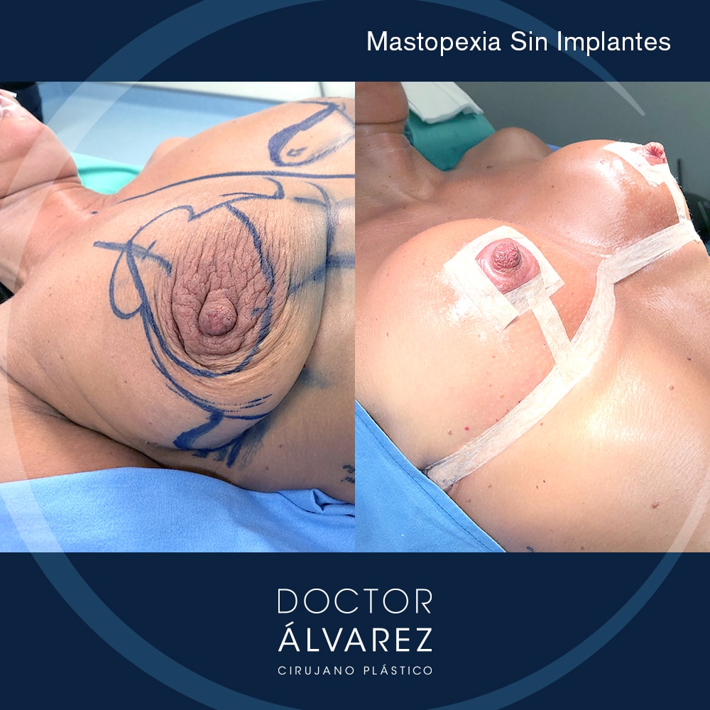 caso paciente mastopexia sin implantes