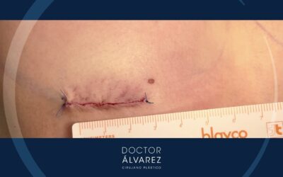 ¿Cómo es la cicatriz de una operación de aumento de pecho?