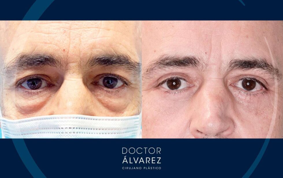 Caso De Blefaroplastia Superior E Inferior Doctor Lvarez