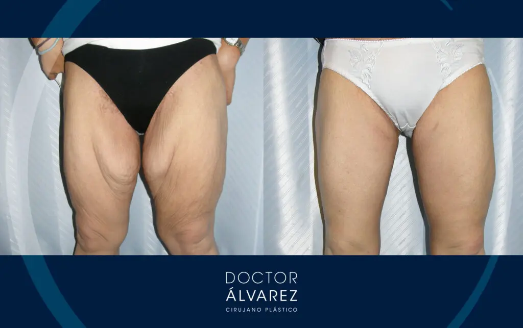 Resultado de un Lifting de Muslos por el Doctor Álvarez