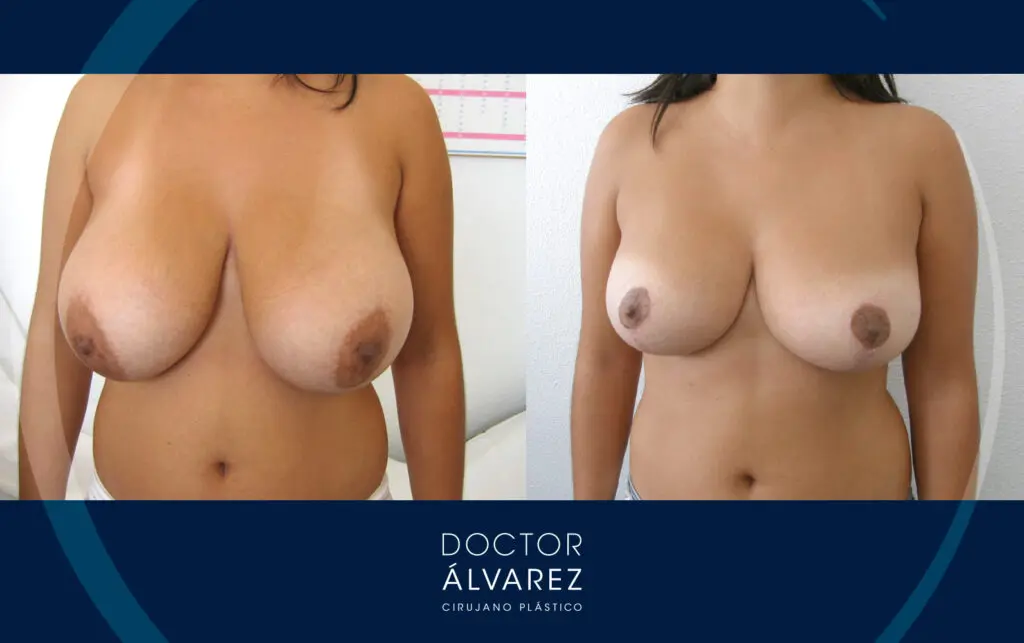 El antes y el después de una reducción mamaria