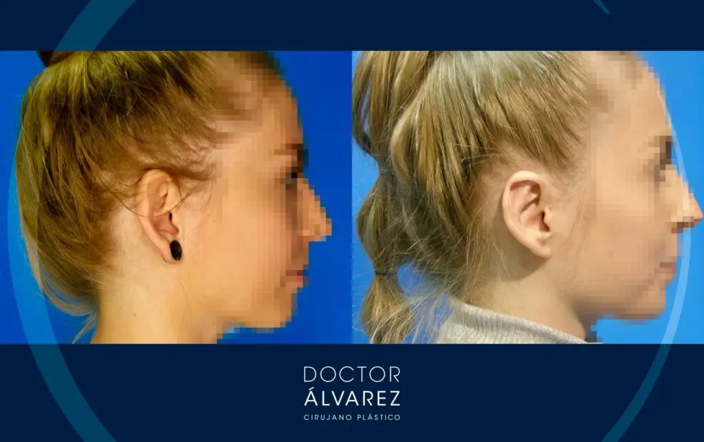 Caso de Otoplastia en una Mujer