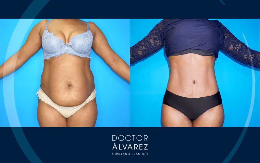 Resultado de una abdominplastia con liposucción