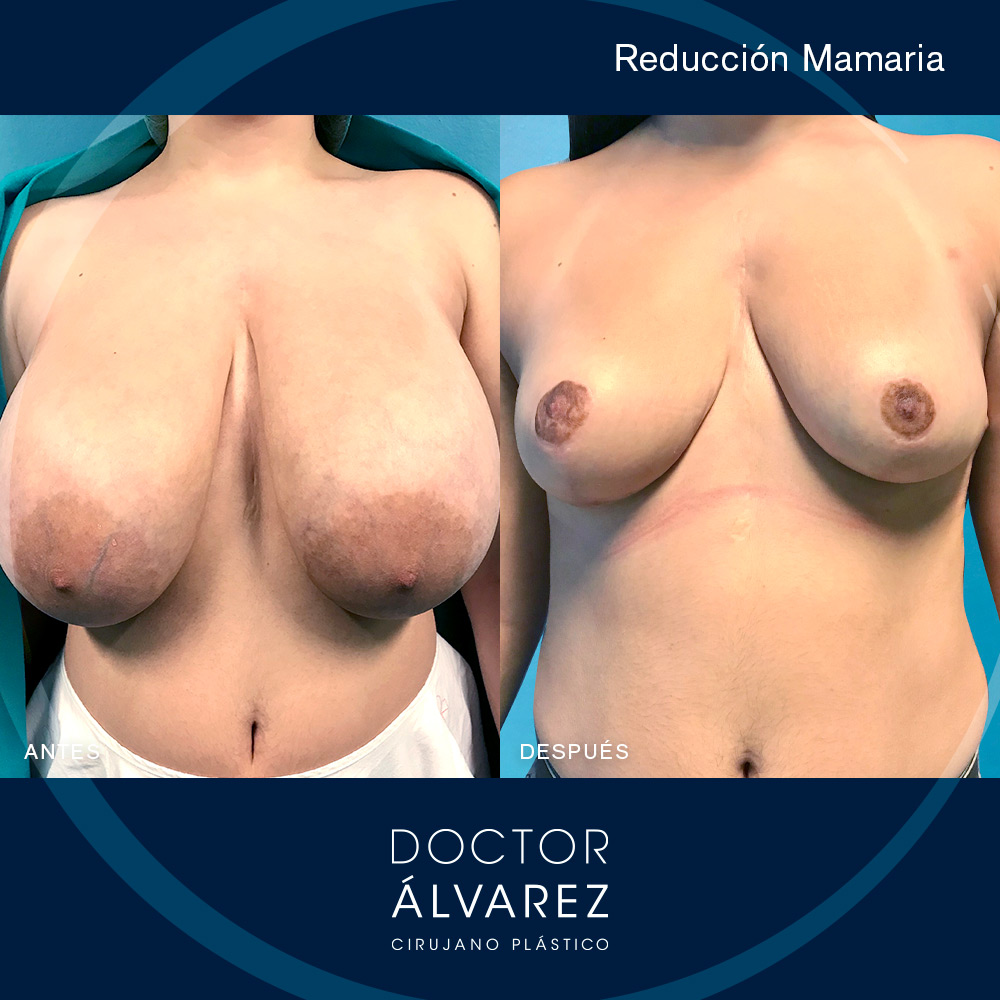 https://cirugiaesteticaplastica.es/caso-de-hipertrofia-mamaria-severa/