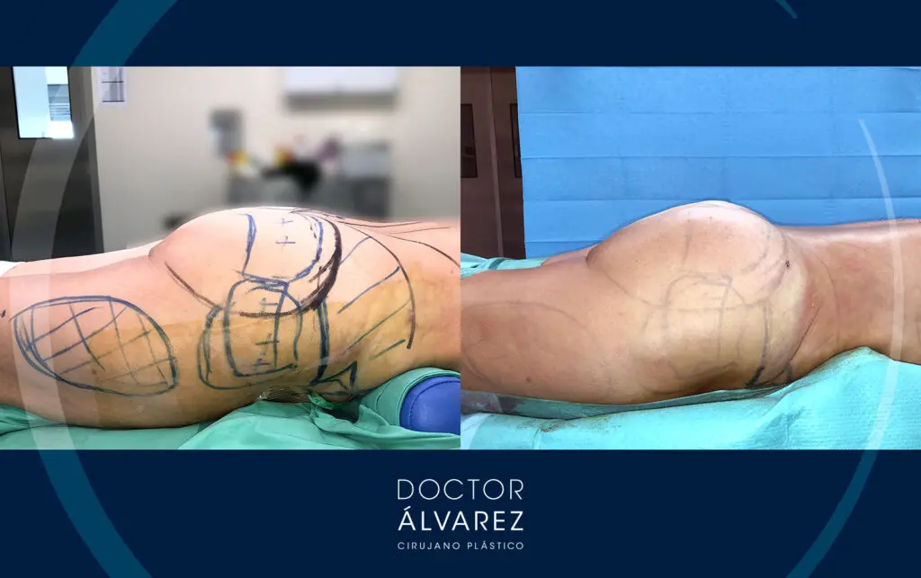 Resultado de un lipoinjerto de gluteo