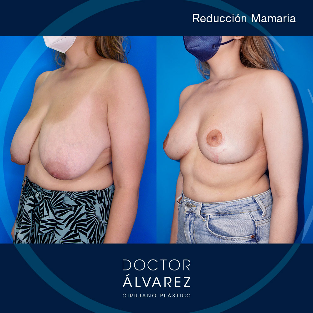 https://cirugiaesteticaplastica.es/caso-de-reduccion-mamaria-con-cicatrices-muy-buenas/