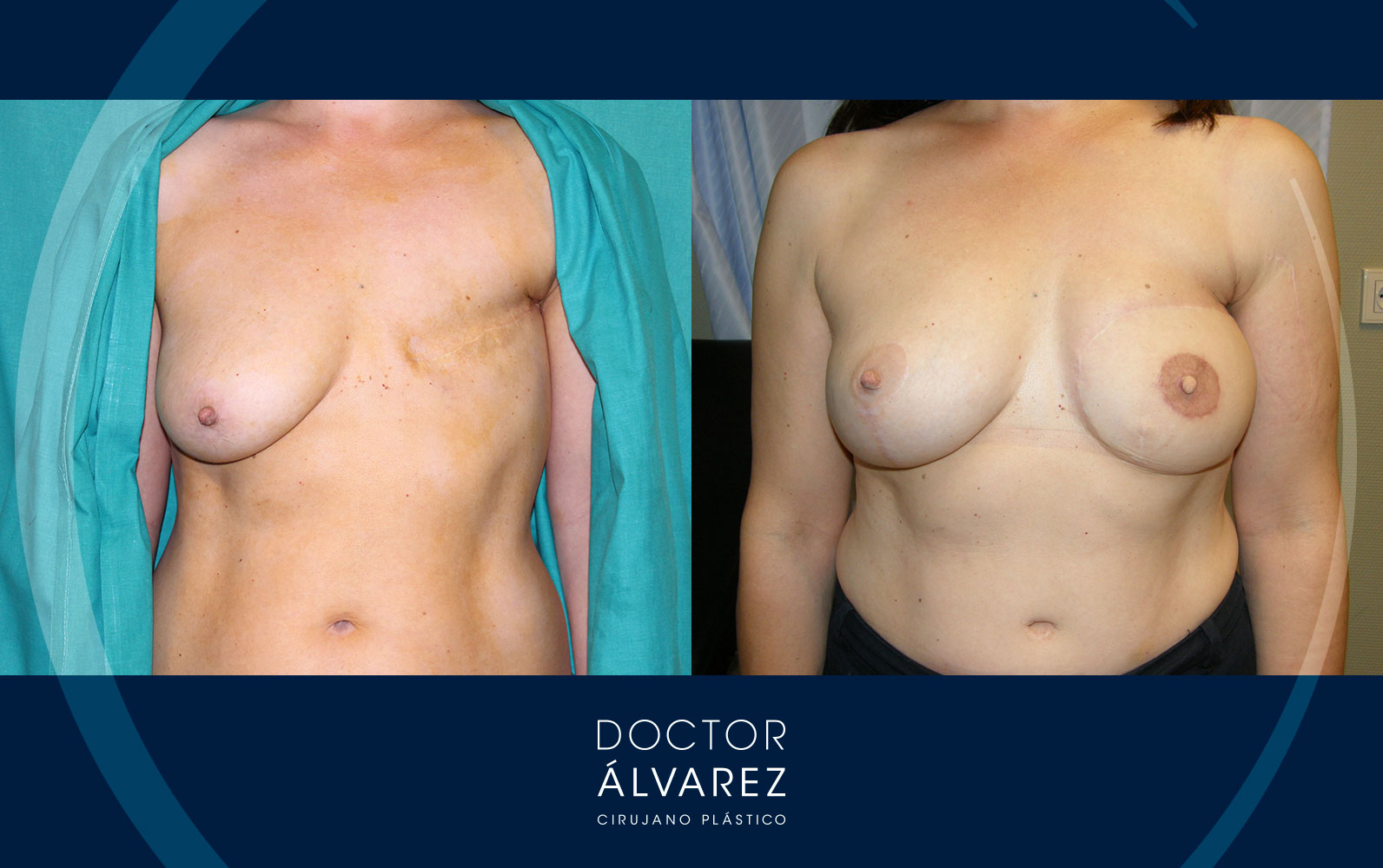 Antes y después de una Reconstrucción mamaria