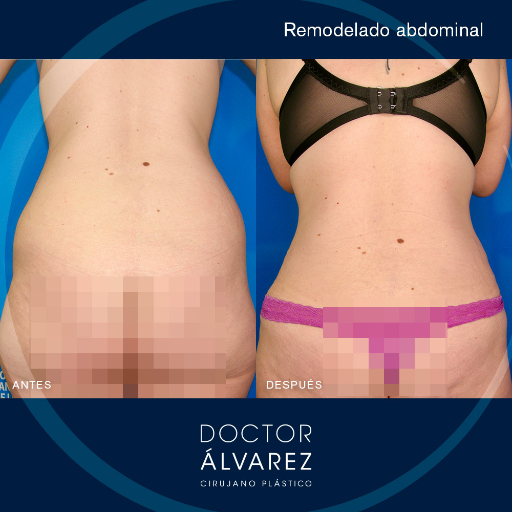 https://cirugiaesteticaplastica.es/caso-de-remodelado-abdominal/