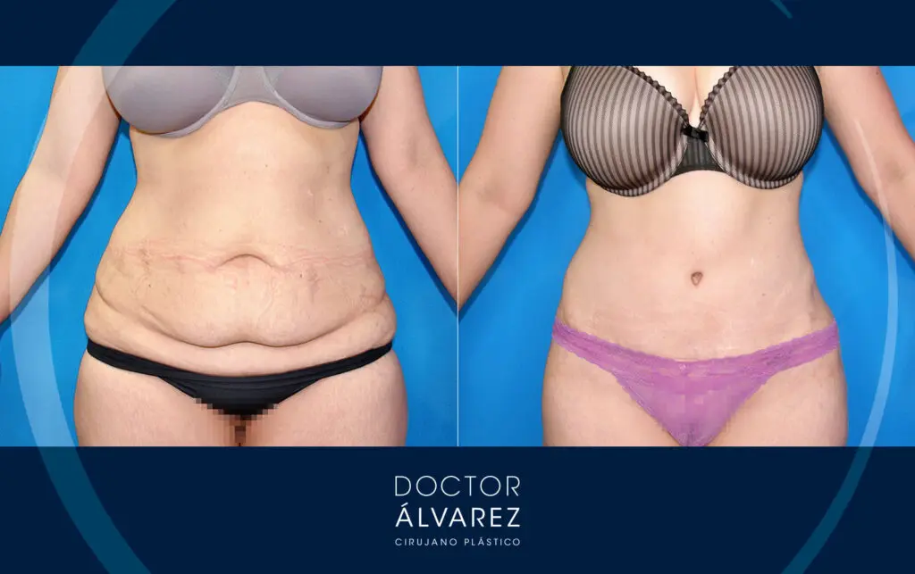 Resultado de un remodelado abdominal