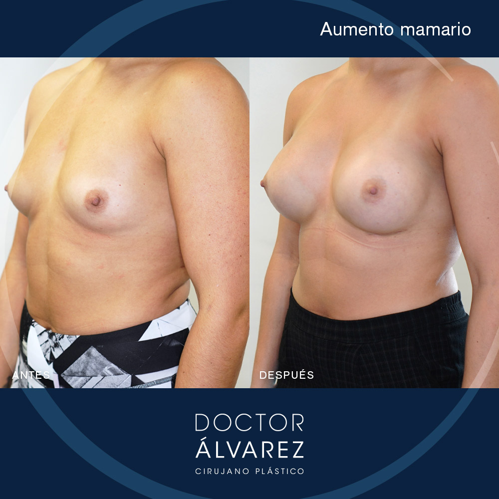 https://cirugiaesteticaplastica.es/caso-de-aumento-mamario-con-implantes-redondos/