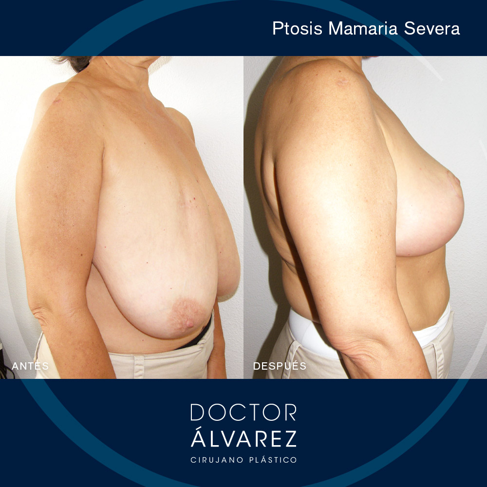 https://cirugiaesteticaplastica.es/caso-de-ptosis-mamaria-severa/
