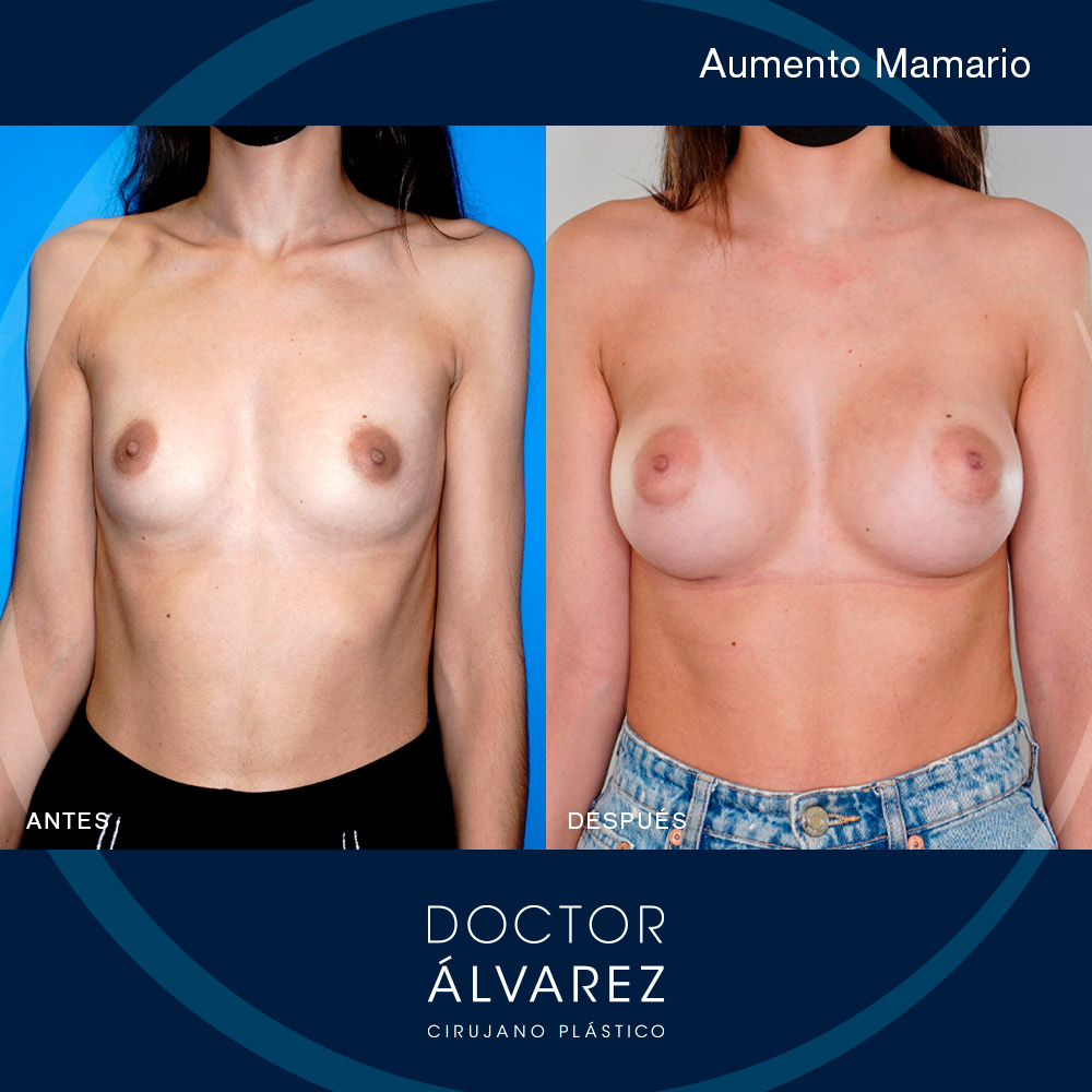 https://cirugiaesteticaplastica.es/caso-de-aumento-mamario-con-protesis-anatomicas/