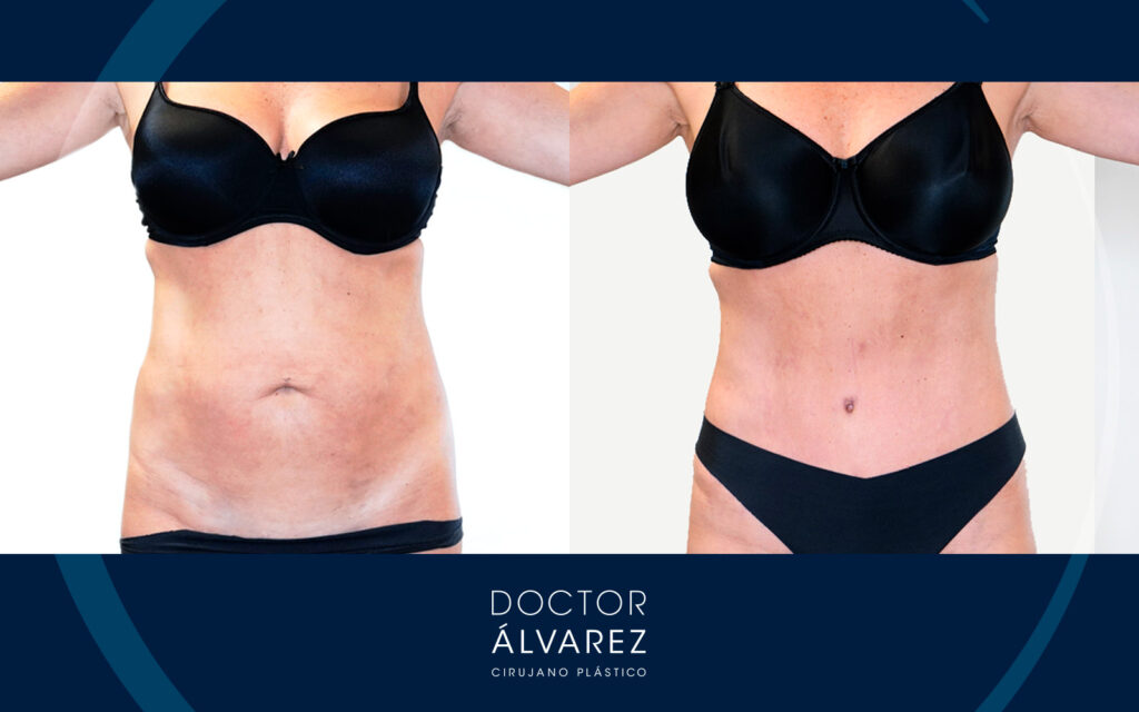 resultado abdominoplastia mujer