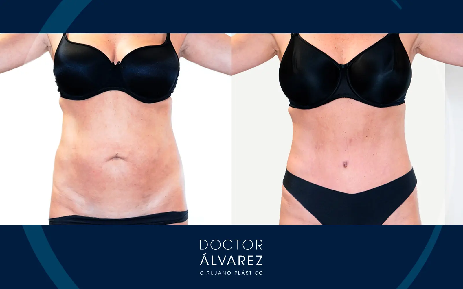 ABDOMINOPLASTIA con aplicatura abdominal 15 dias después. MEDIFORMAS ☎️099  8009266, ABDOMINOPLASTIA RECONSTRUCTIVA con aplicatura abdominal.  Resultados 15 días después de su cirugía. ¿Deseas información sobre este u  otro procedimiento?