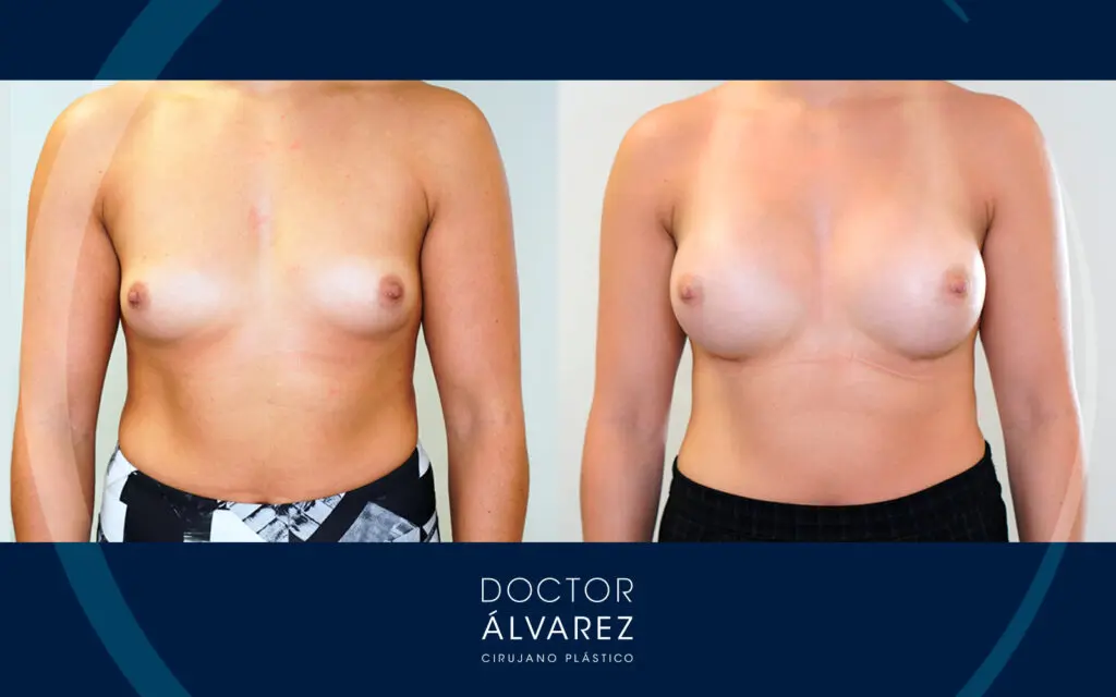antes y después de un aumento de pecho con implantes redondos