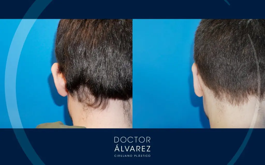 Resultado otoplastia en chico joven