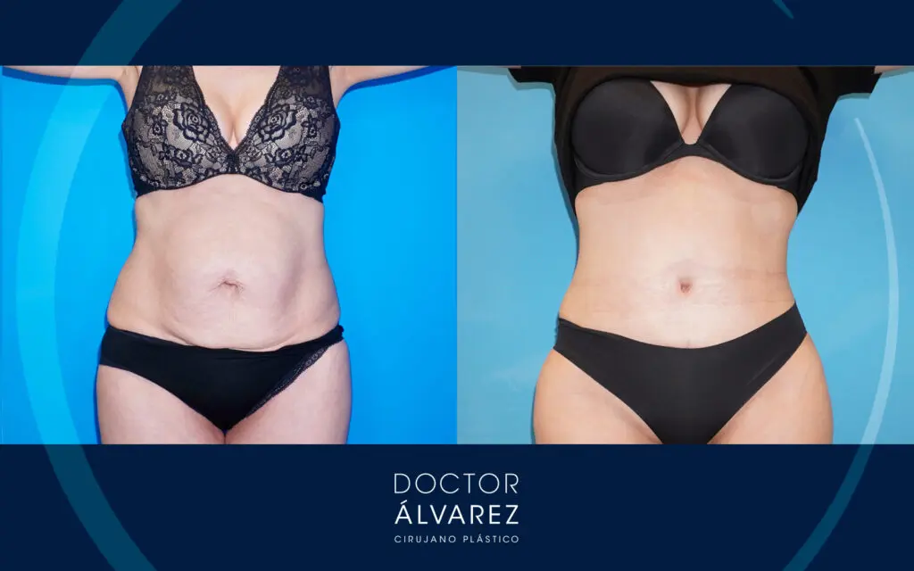 fotos del antes y después de una plicatura abdominal