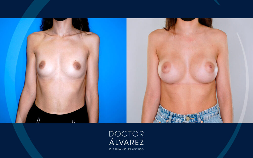 fotos de resultado de un aumento de pecho con prótesis anatómicas