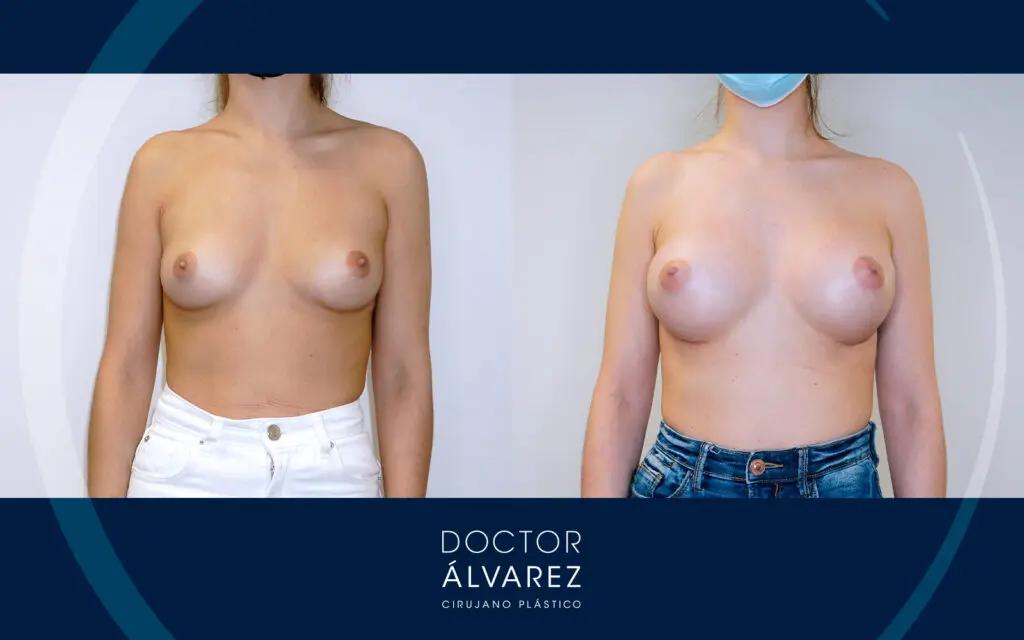 Resultado de un aumento mamario natural con implantes redondos