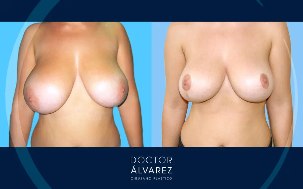 Resultado con antes y después de una mastopexia