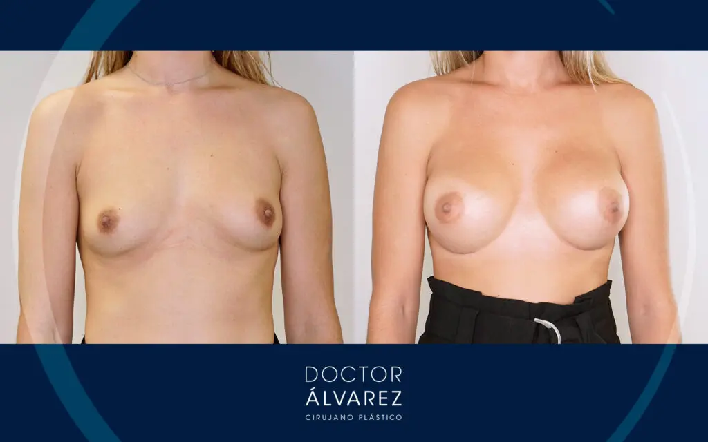 Aumento de pecho con implantes redondos con diferente volumen