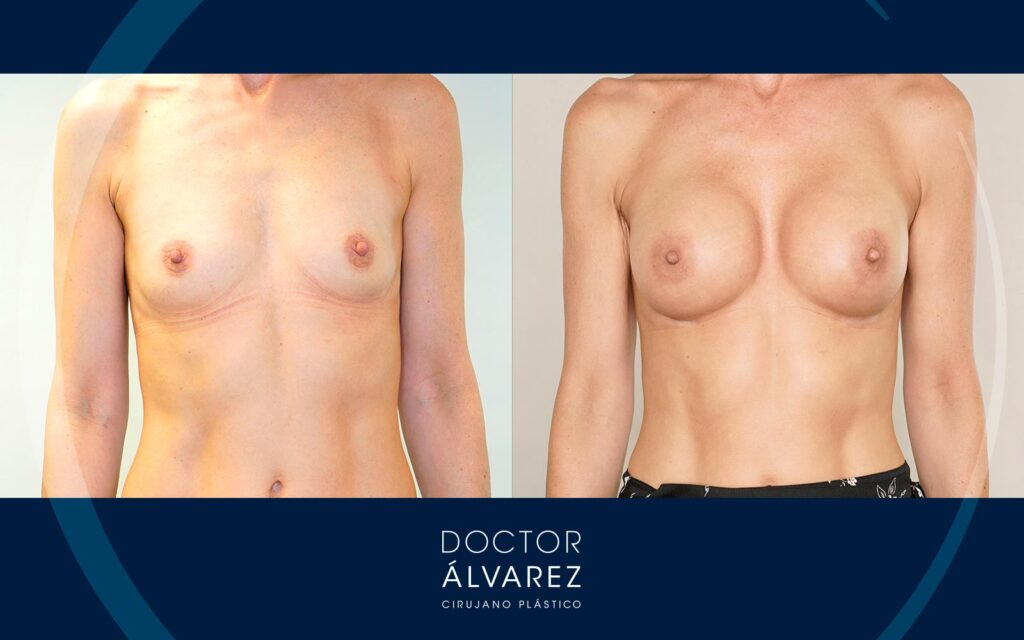 Implantes anatómicos de 275 cc