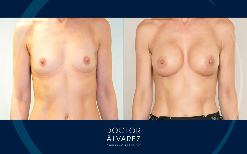 Implantes anatómicos de 275 cc