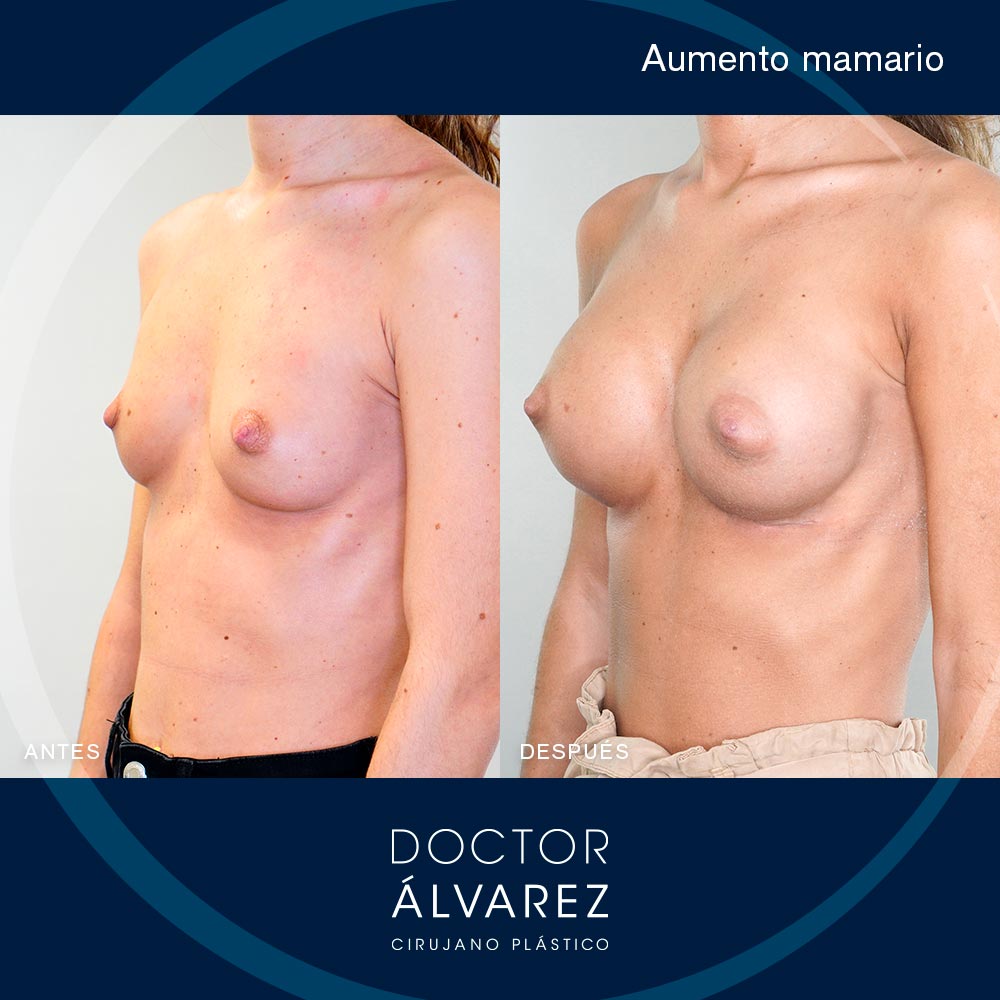 https://cirugiaesteticaplastica.es/caso-de-aumento-de-pecho-con-implantes-de-255cc/