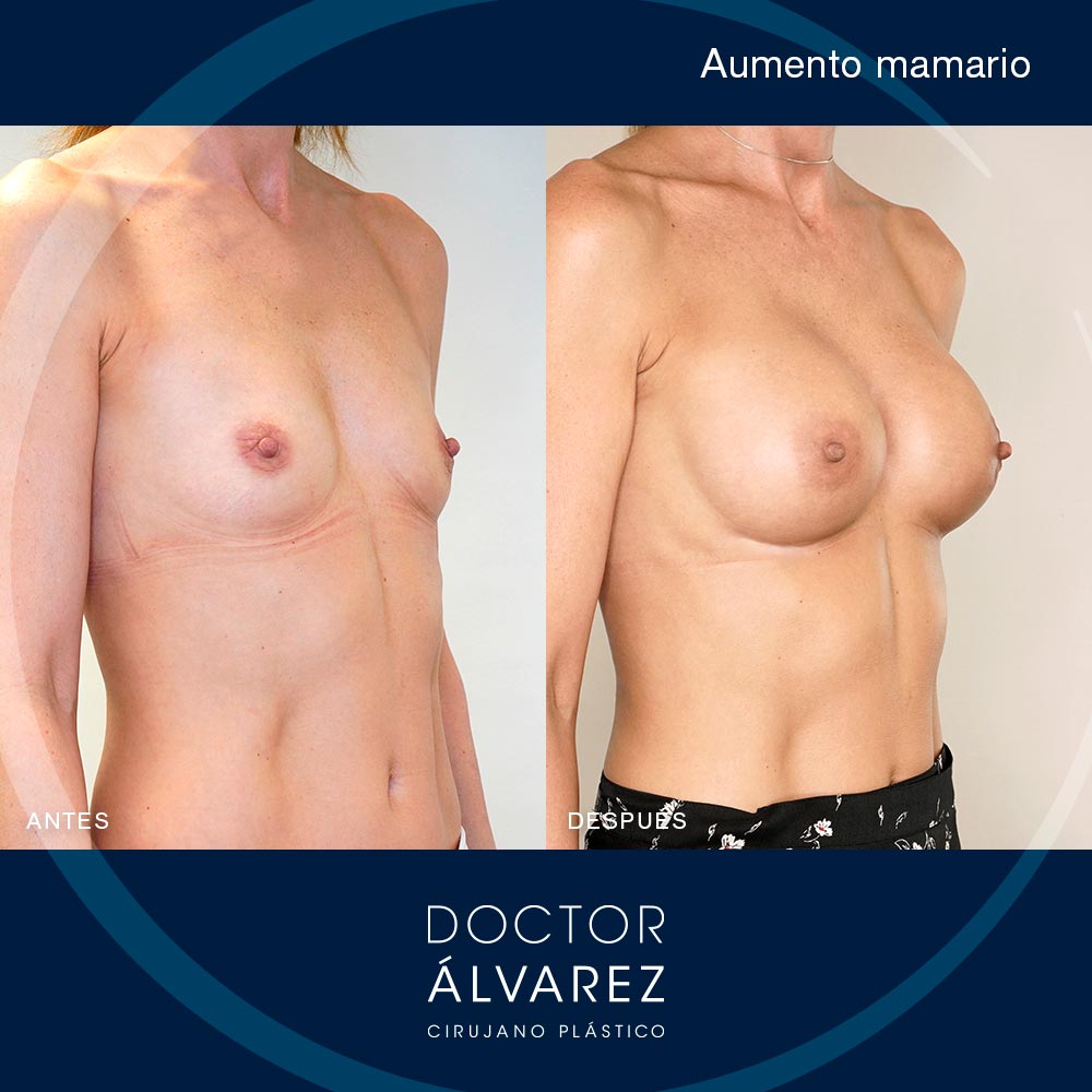https://cirugiaesteticaplastica.es/caso-de-aumento-mamario-con-implantes-anatomicos-de-275cc/