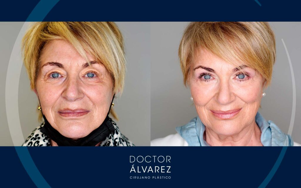 antes y después de una blefaroplastia