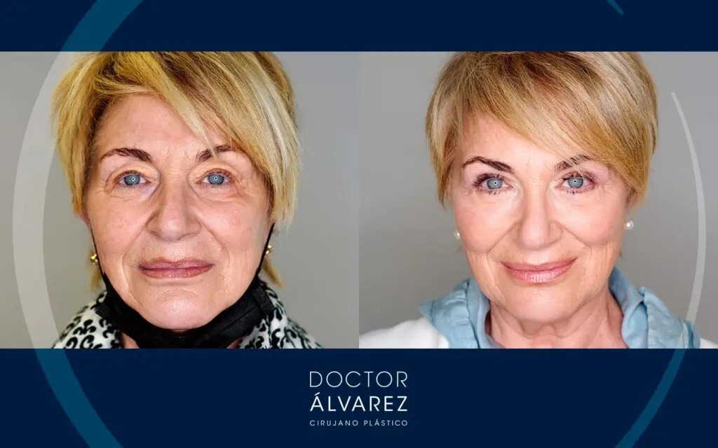 antes y después de una blefaroplastia