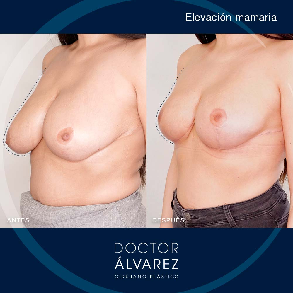 https://cirugiaesteticaplastica.es/caso-de-elevacion-mamaria/