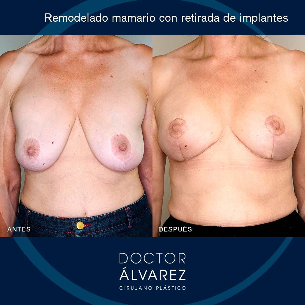 https://cirugiaesteticaplastica.es/caso-de-remodelado-mamario-con-retirada-de-implantes/