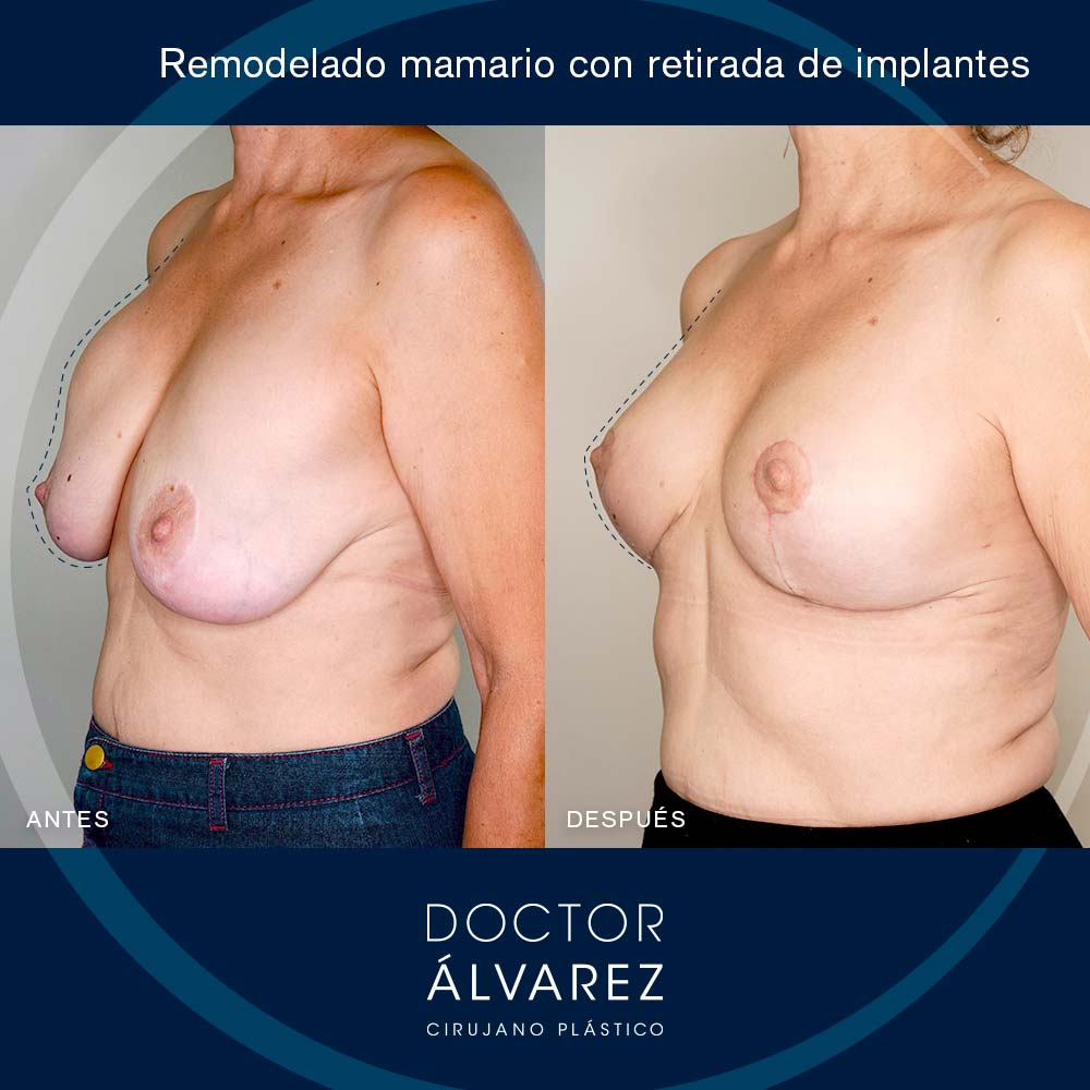 https://cirugiaesteticaplastica.es/caso-de-remodelado-mamario-con-retirada-de-implantes/