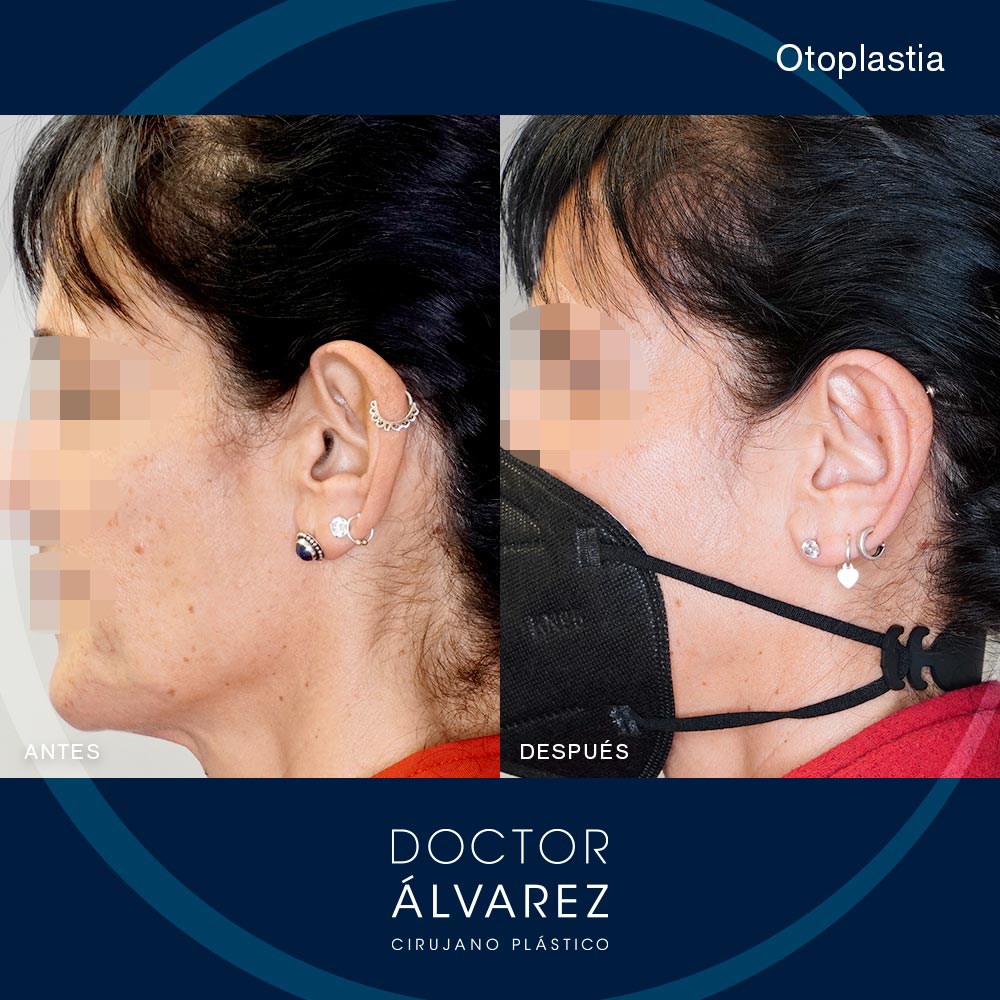 https://cirugiaesteticaplastica.es/caso-de-otoplastia-correccion-de-orejas-prominentes/