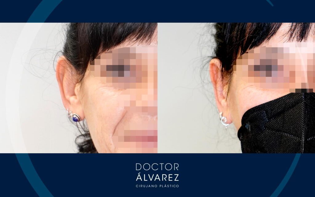 Corrección de orejas prominentes