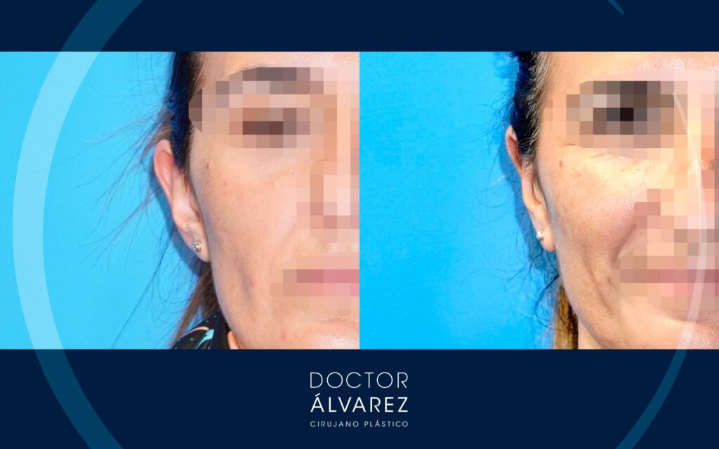 Otoplastia corrección orejas soplillo