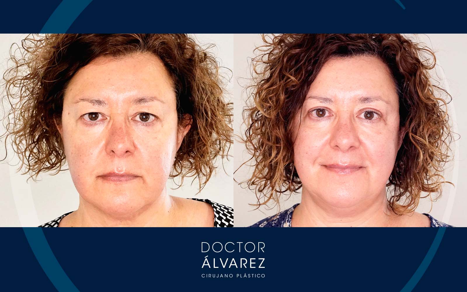 Caso de Blefaroplastia Superior