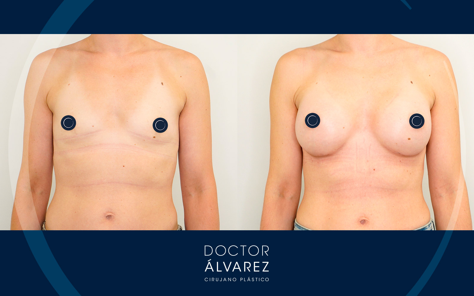 Casos reales 43 Aumento mamario en hipoplasia severa