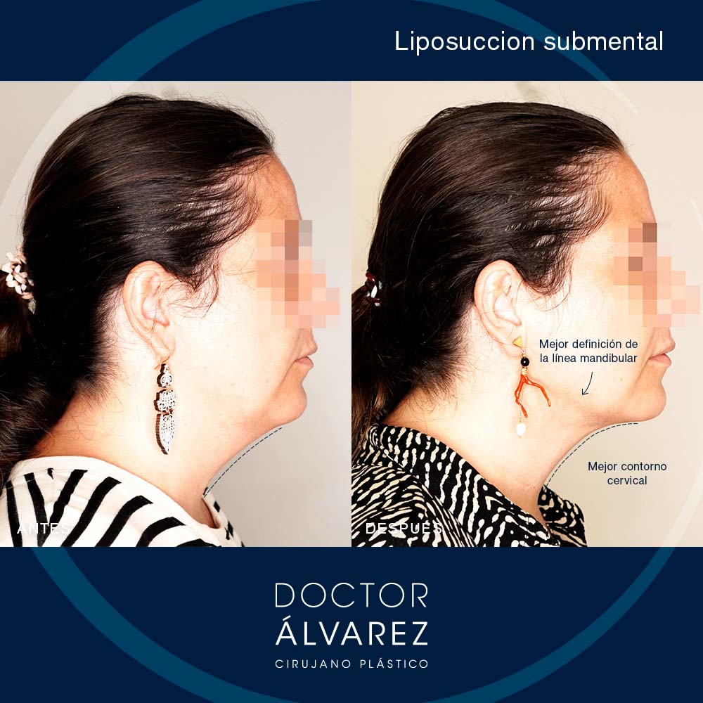 https://cirugiaesteticaplastica.es/caso-de-liposuccion-submental/