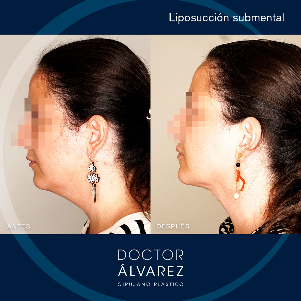 https://cirugiaesteticaplastica.es/caso-de-liposuccion-submental/