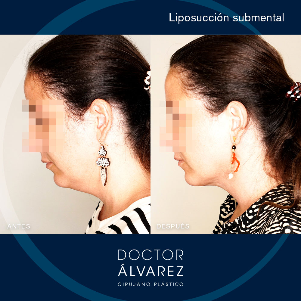 https://cirugiaesteticaplastica.es/caso-de-liposuccion-submental/