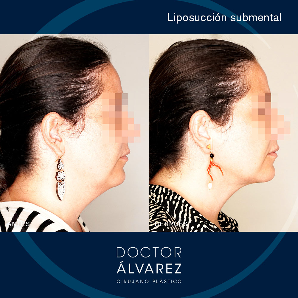 https://cirugiaesteticaplastica.es/caso-de-liposuccion-submental/